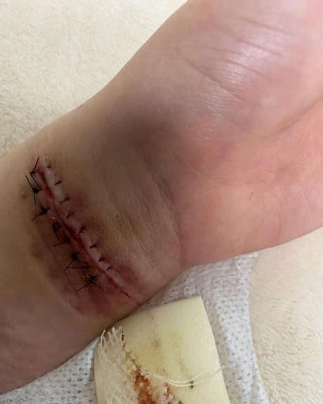 AOA权珉娥再次割腕自杀 神经线断了不打麻药缝合_韩饭网